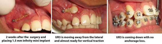 retract impacted canine with TADs mini implants 